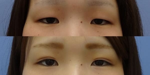 仙台でまぶたを軽くしたい 上眼瞼眼窩脂肪除去 上まぶたの脂肪取り ｃｌａｓｓｙ仙台美容外科 美容皮膚科