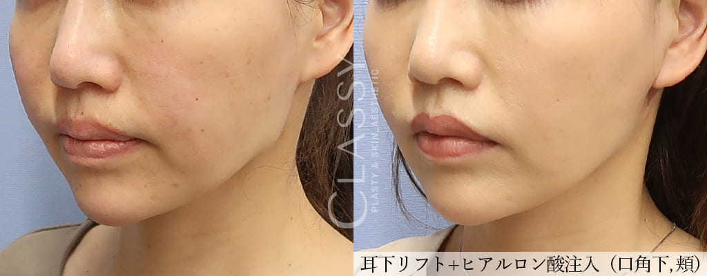 仙台で外科手術でリフトアップ たるみ取り 耳下リフト ｃｌａｓｓｙ仙台美容外科 美容皮膚科