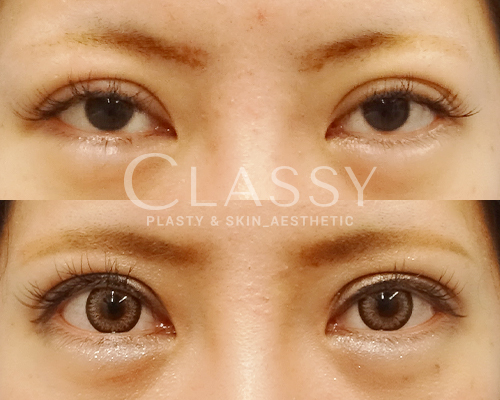 仙台で開けづらい目の治療 眼瞼下垂 挙筋前転法 ｃｌａｓｓｙ仙台美容外科 美容皮膚科