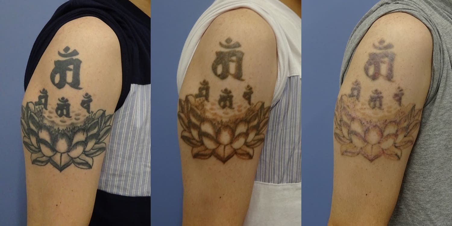 仙台でのピコレーザーによる刺青 タトゥー除去 ｃｌａｓｓｙ仙台美容外科 美容皮膚科