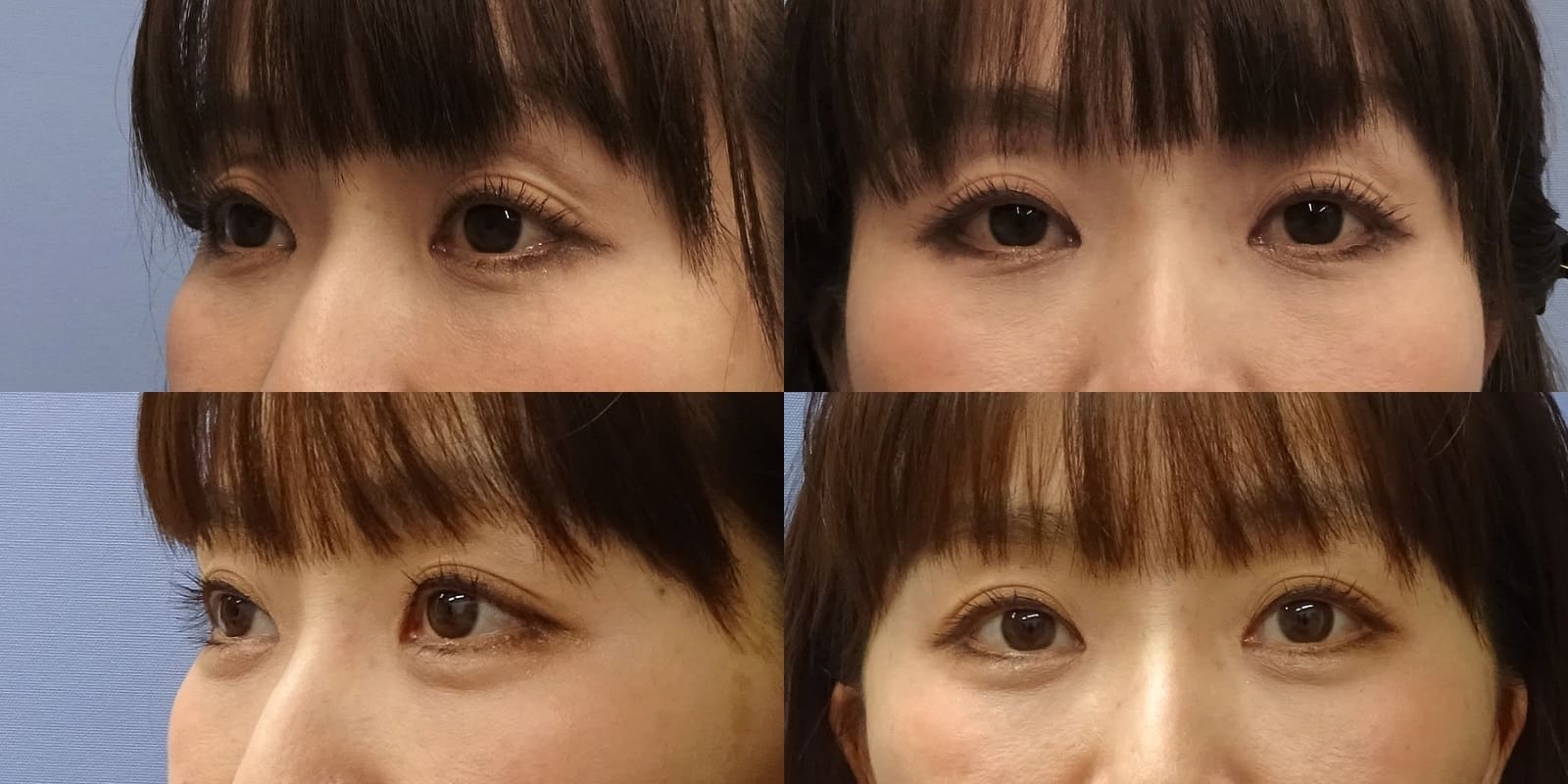 仙台で可愛らしい目元に ヒアルロン酸注入 涙袋 Classy 仙台美容外科 美容皮膚科