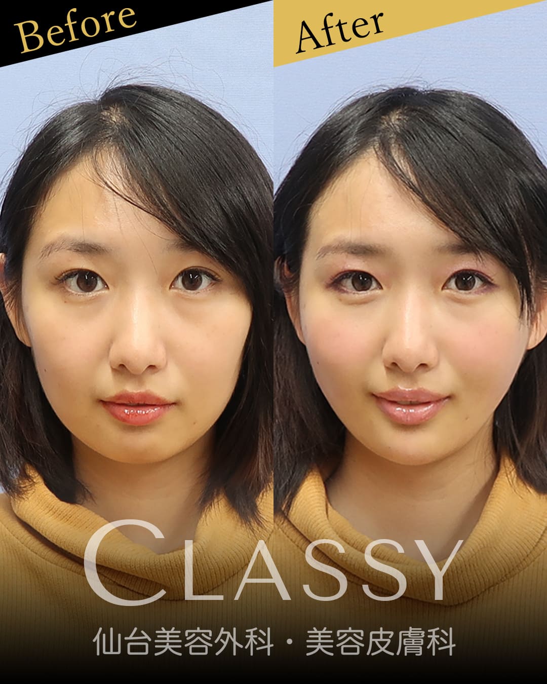 顔 リフト 自然な表情と作る、フェイスリフト・切開リフトアップ｜韓国美容整形 ｜ID美容外科