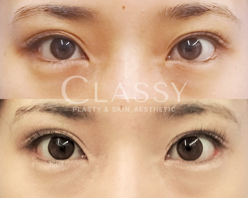 仙台で目を大きくしたり垂れ目にしたい 目尻切開法 ｃｌａｓｓｙ仙台美容外科 美容皮膚科