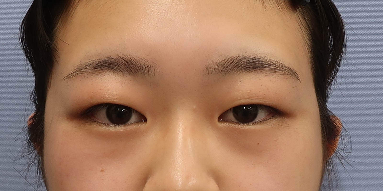 たるみ取り併用全切開法二重術 3か月後経過一例 ｃｌａｓｓｙ仙台美容外科 美容皮膚科