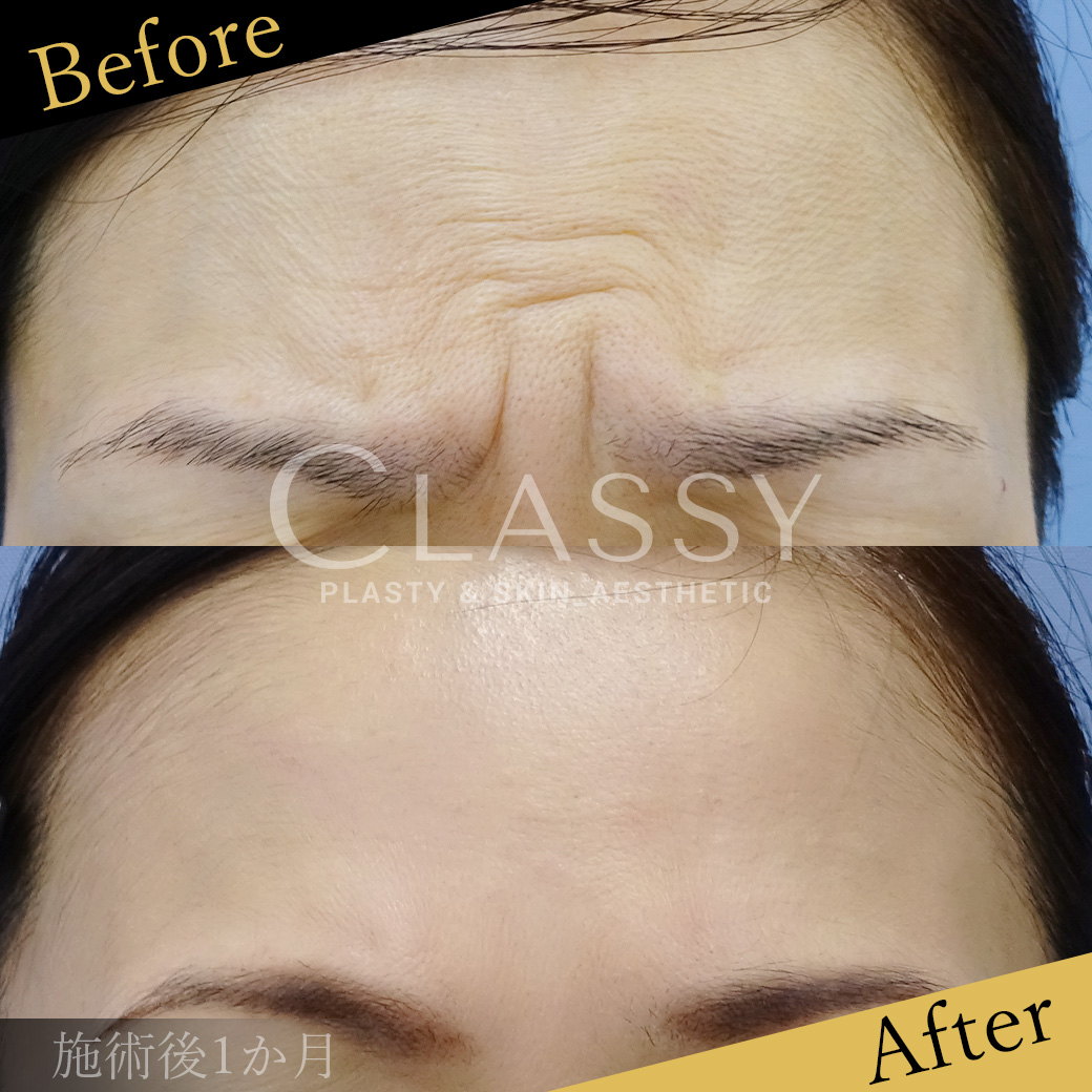 仙台でシワ取り！ボトックス（ボツリヌストキシン）注射 | CLASSY 仙台 