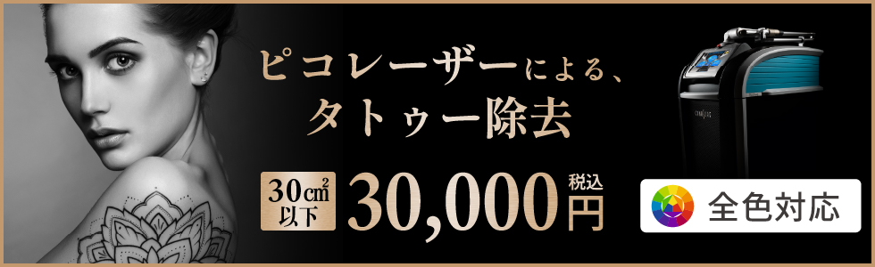 ピコレーザーによるタトゥー除去