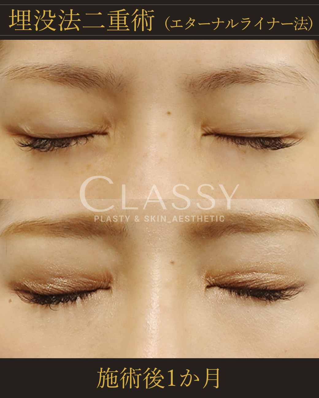 埋没法二重術エターナルライナー法_施術後1か月 | CLASSY仙台美容外科・美容皮膚科