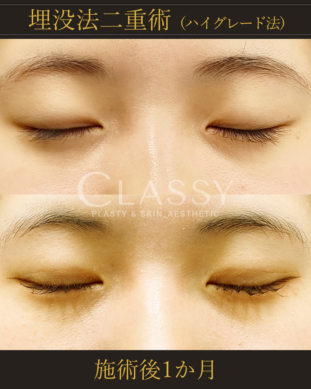 埋没法二重術ハイグレード法_施術後1か月 | CLASSY仙台美容外科・美容皮膚科