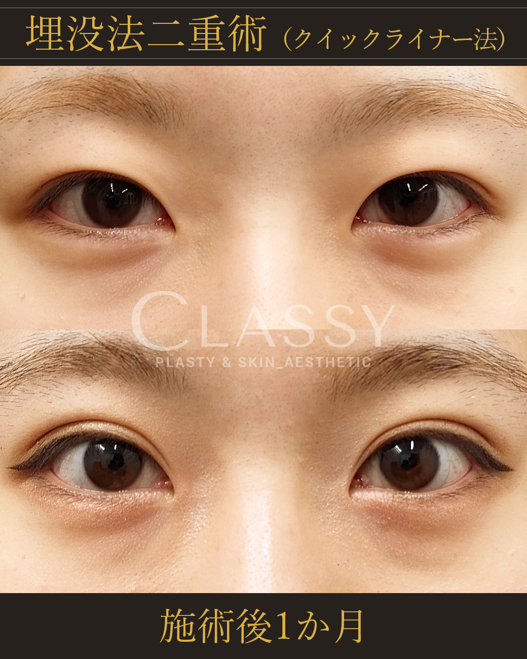 埋没法二重術クイックライナー法_施術後1か月 | CLASSY仙台美容外科・美容皮膚科