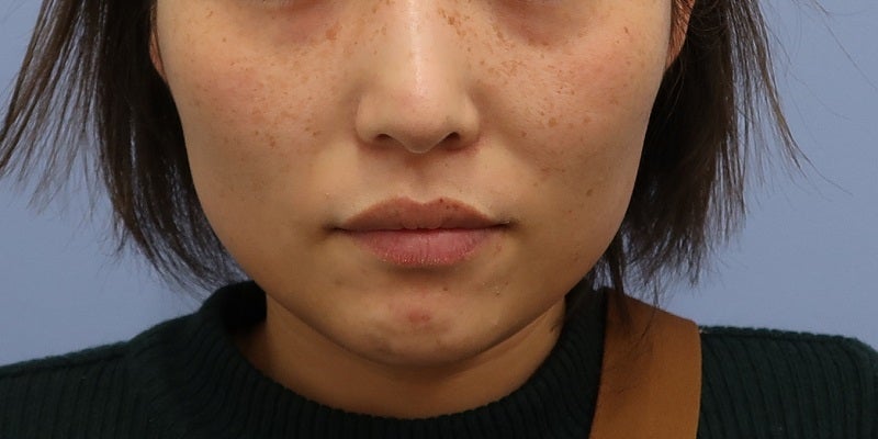 症例写真：施術前