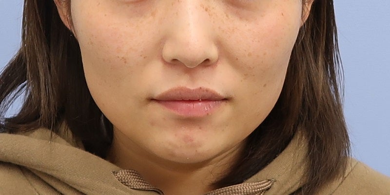 症例写真：2回目前