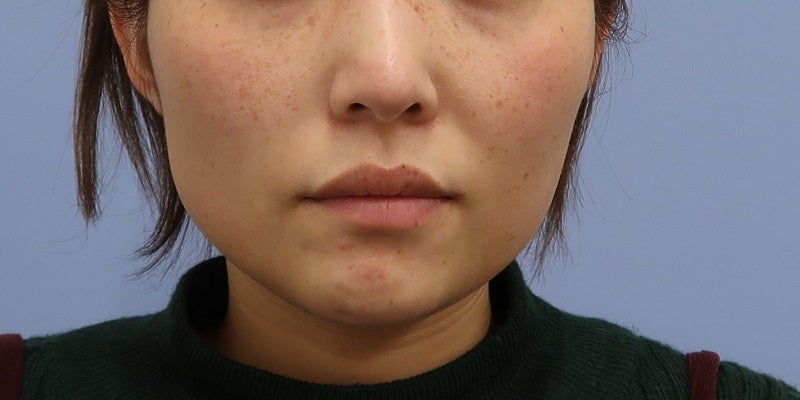 症例写真：3回目前