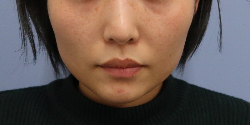 症例写真：4回目前