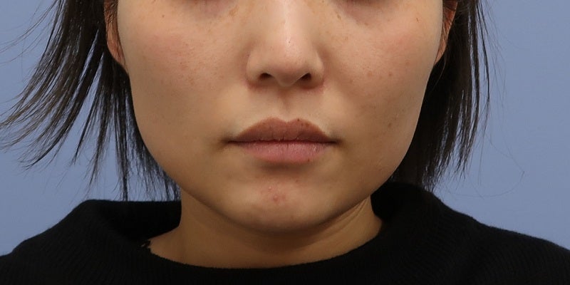 症例写真：5回目前