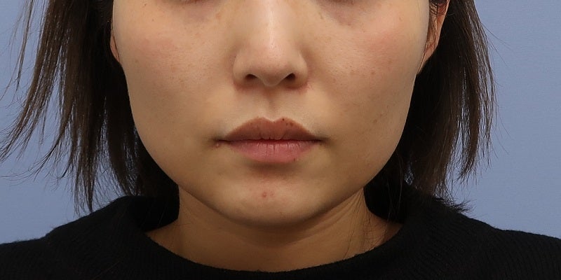 症例写真：6回目前