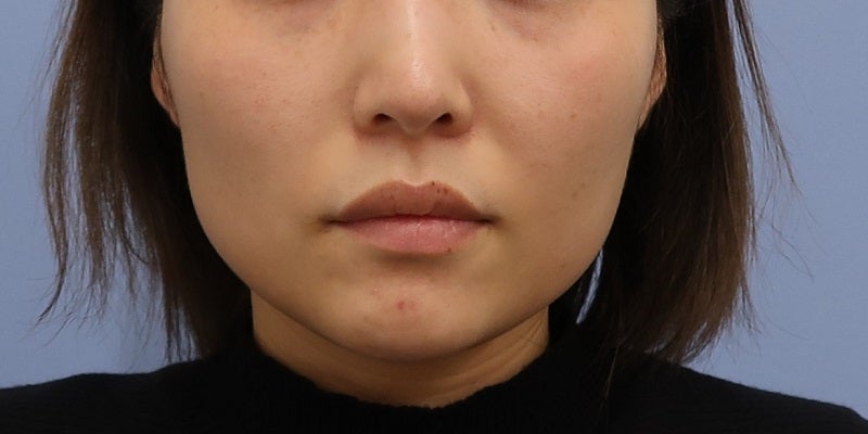 症例写真：7回目前