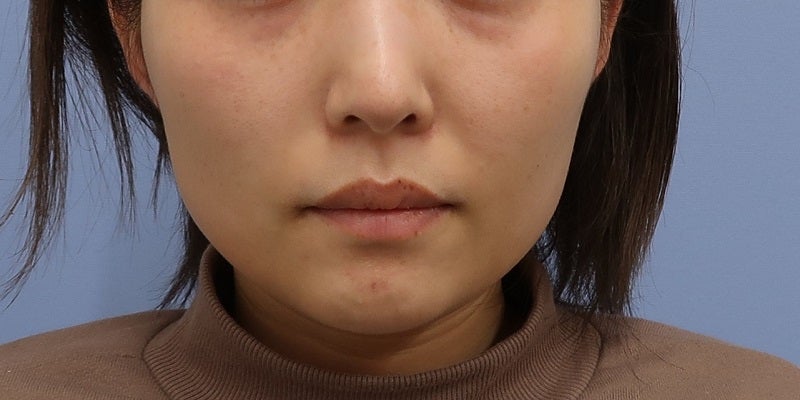 症例写真：8回目前