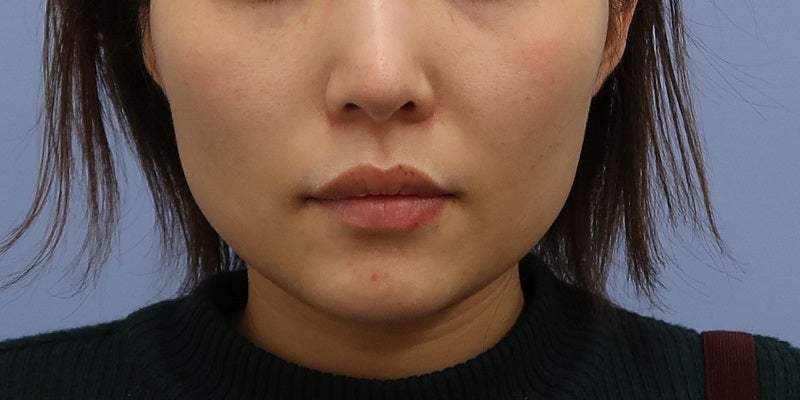 症例写真：9回目前