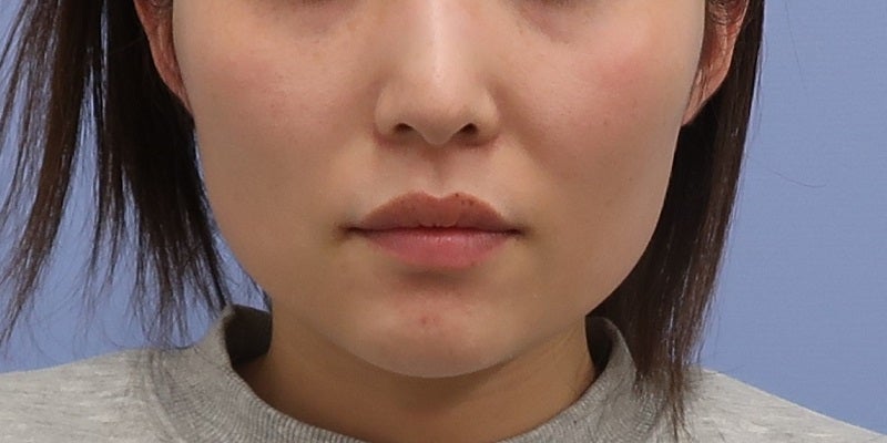 症例写真：10回目前