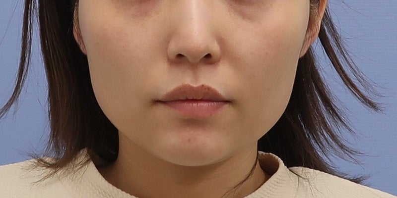 症例写真：10回照射後