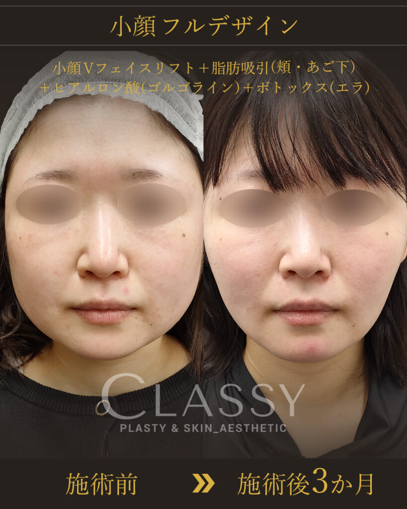 *小顔フルデザイン（頬・アゴ下の脂肪吸引+小顔Vフェイスリフト＋注入）　施術後3か月までの経過一例