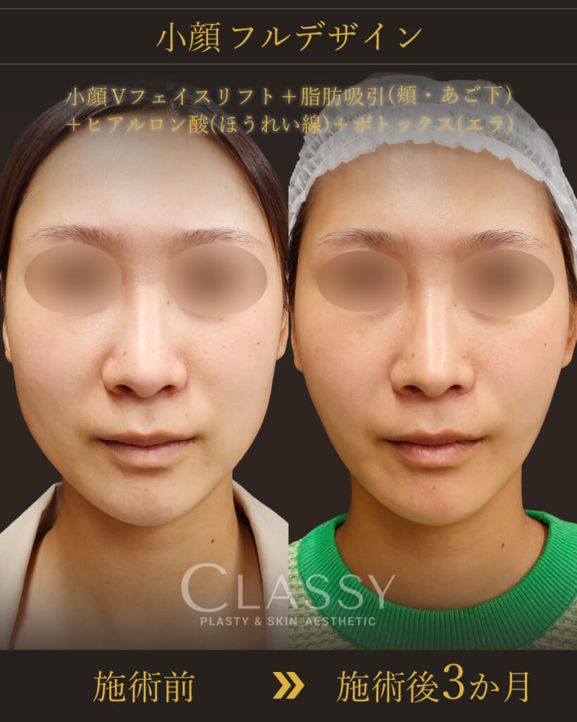 *小顔フルデザイン（頬・アゴ下の脂肪吸引+小顔Vフェイスリフト＋注入）　施術後3か月までの経過一例